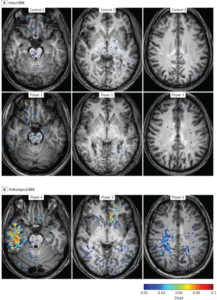 The images from the Ben-Gurion University of the Negev JAMA Neurology study represent Blood-Brain Barrier (BBB) Permeability in Football Players (A) vs. a control group (B). The players in the pathological-BBB group (B) presented focal BBB lesions in different cortical regions including the temporal (player 4), frontal (player 5), and parietal (player 6) lobes. Both gray and white matter were involved.