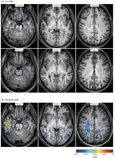 The images from the Ben-Gurion University of the Negev JAMA Neurology study represent Blood-Brain Barrier (BBB) Permeability in Football Players (A) vs. a control group (B). The players in the pathological-BBB group (B) presented focal BBB lesions in different cortical regions including the temporal (player 4), frontal (player 5), and parietal (player 6) lobes. Both gray and white matter were involved.